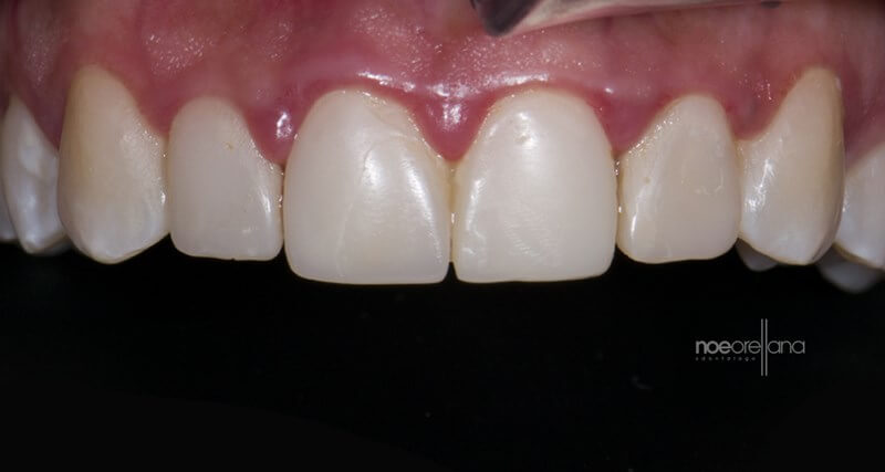 Figure 1: Gingival Inflammation