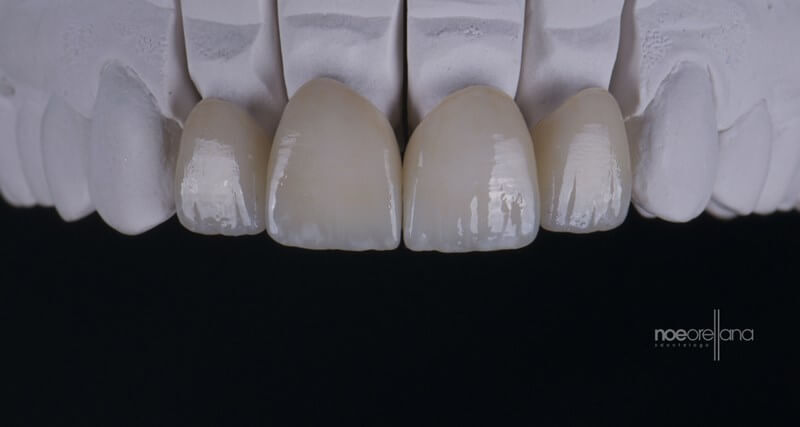 Figure 3: Lithium Disilicate Restorations With Surface Stain Technique